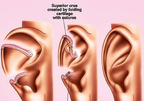 Endoscopic Surgery